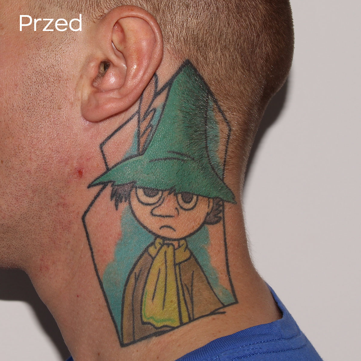 usuwanie laserowe tatuażu